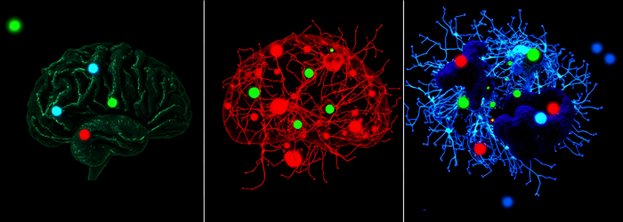 Triple comparison: 1) Alzheimer's disease (amyloid plaques) 2) Amyotrophic lateral sclerosis (TDP-43 aggregates) 3) Parkinson's disease (Lewy bodies)