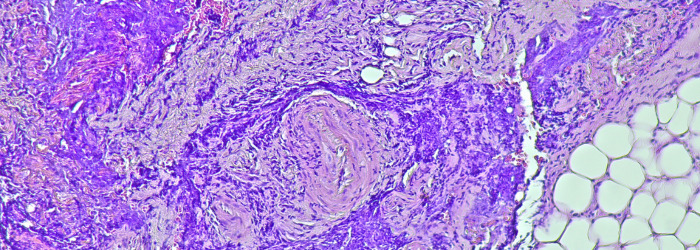 tumour