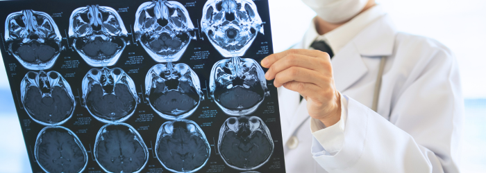 Doctor holding up brain scan