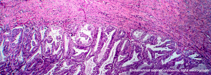 Endometrial adenocarcinoma, light micrograph